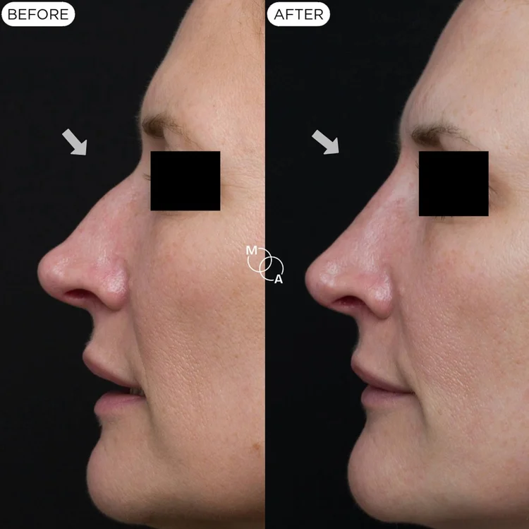 Non-surgical rhinoplasty before and after, profile view, dorsal hump, Mindful Aesthetics Reigate