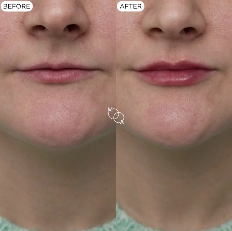 Lip filler before and after, subtle volume and definition, Reigate Surrey