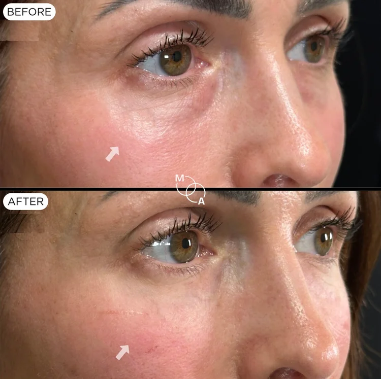 Tear trough filler before and after, close-up of under-eye shadowing, Reigate Surrey
