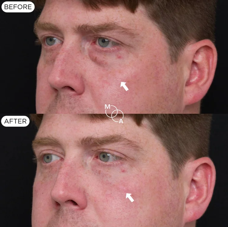 Tear trough filler before and after, close-up of the under-eye hollow, Mindful Aesthetics Reigate