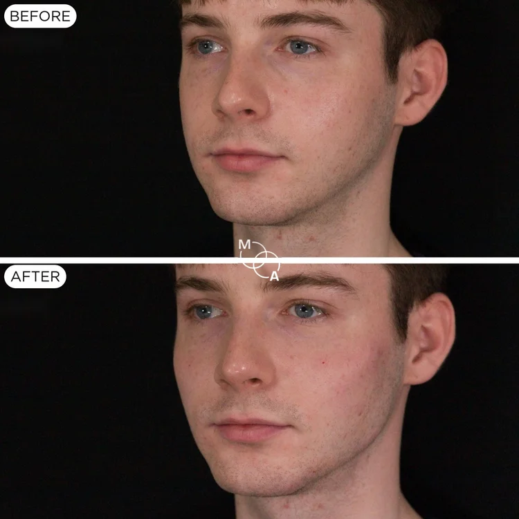 Cheek filler before and after, three-quarter view, male patient, Mindful Aesthetics Reigate