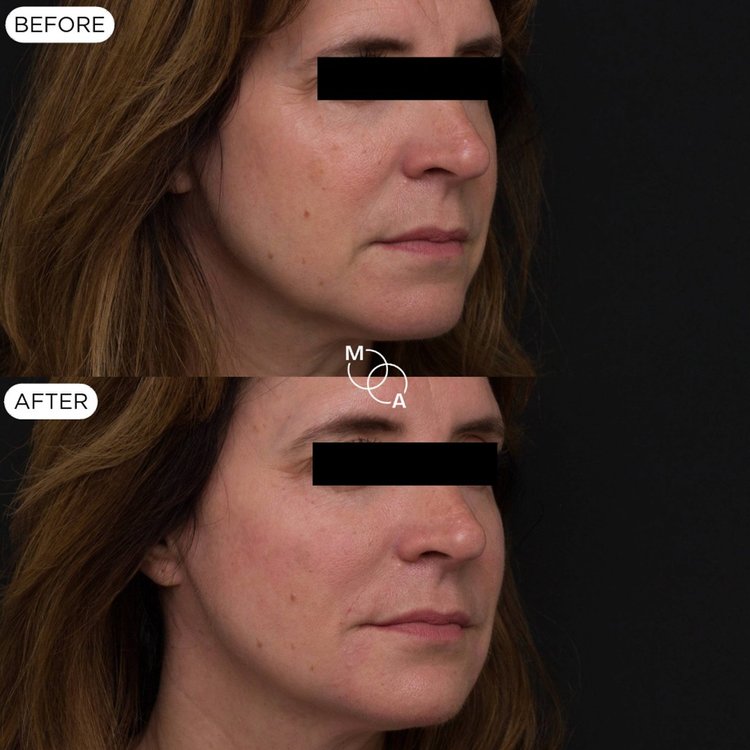 Nasolabial fold filler before and after, three-quarter view, Reigate Surrey