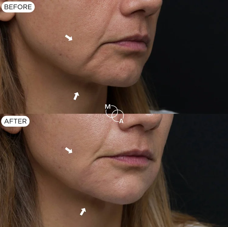 Nasolabial and marionette filler before and after, close-up of the lower face, Mindful Aesthetics Reigate