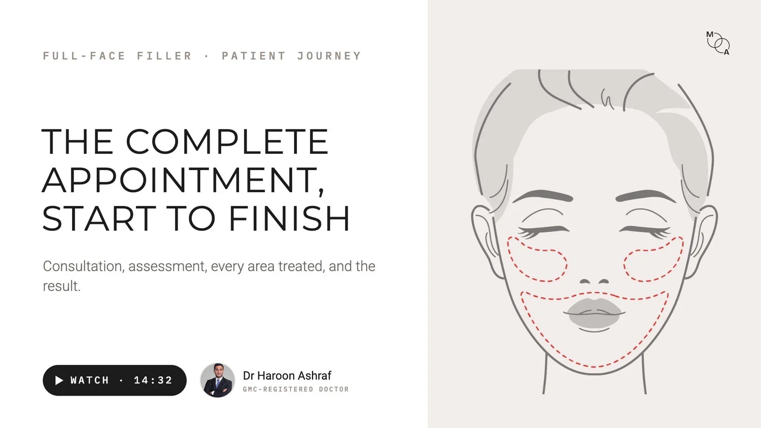 Video poster: the complete full-face filler appointment, start to finish, at Mindful Aesthetics in Reigate