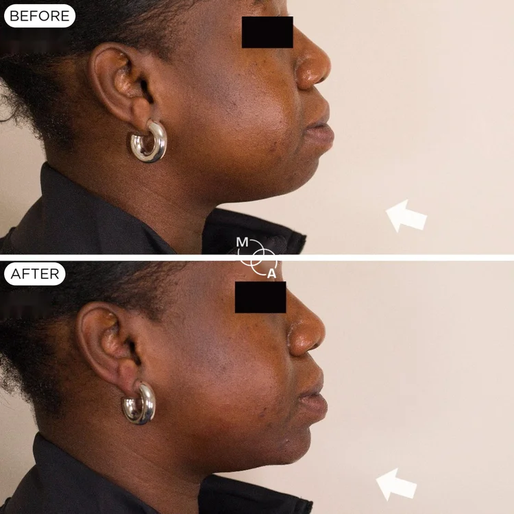 Chin and jawline filler before and after, profile view, Mindful Aesthetics Reigate