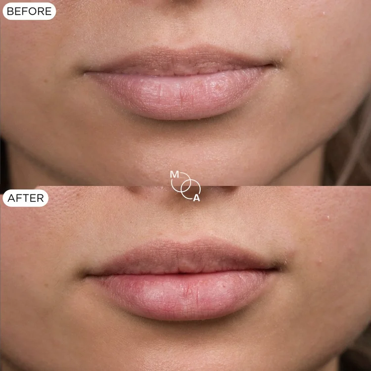 Lip filler before and after, lip shape correction, Mindful Aesthetics Reigate