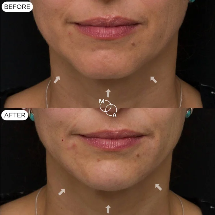 Jawline filler before and after, front view of the lower face, Reigate Surrey
