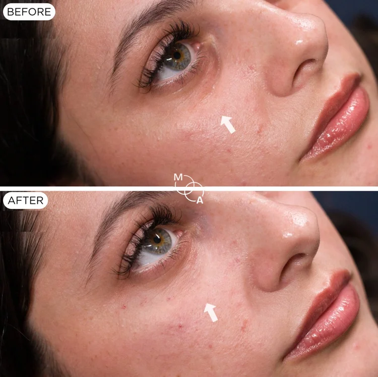 Tear trough filler before and after, close-up at a three-quarter angle, Reigate Surrey
