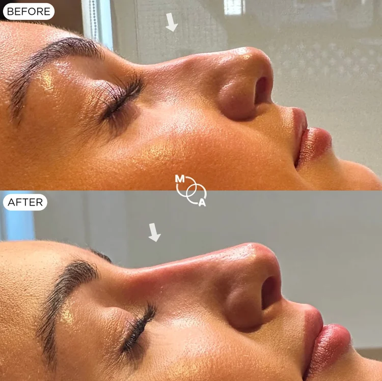 Non-surgical rhinoplasty before and after, profile close-up of the bridge and tip, Reigate Surrey
