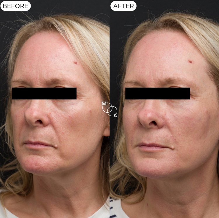 Nasolabial and marionette filler before and after, front view, Mindful Aesthetics Reigate