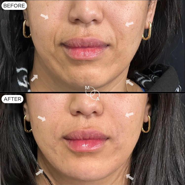 Nasolabial and marionette filler before and after, front view of the lower face, Reigate Surrey