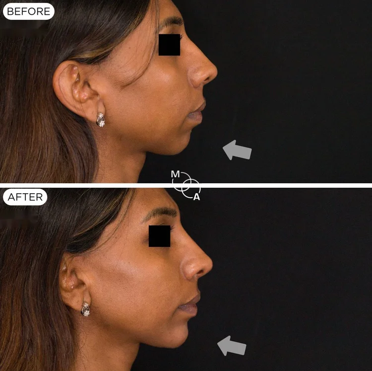 Chin filler before and after, profile view, Reigate Surrey
