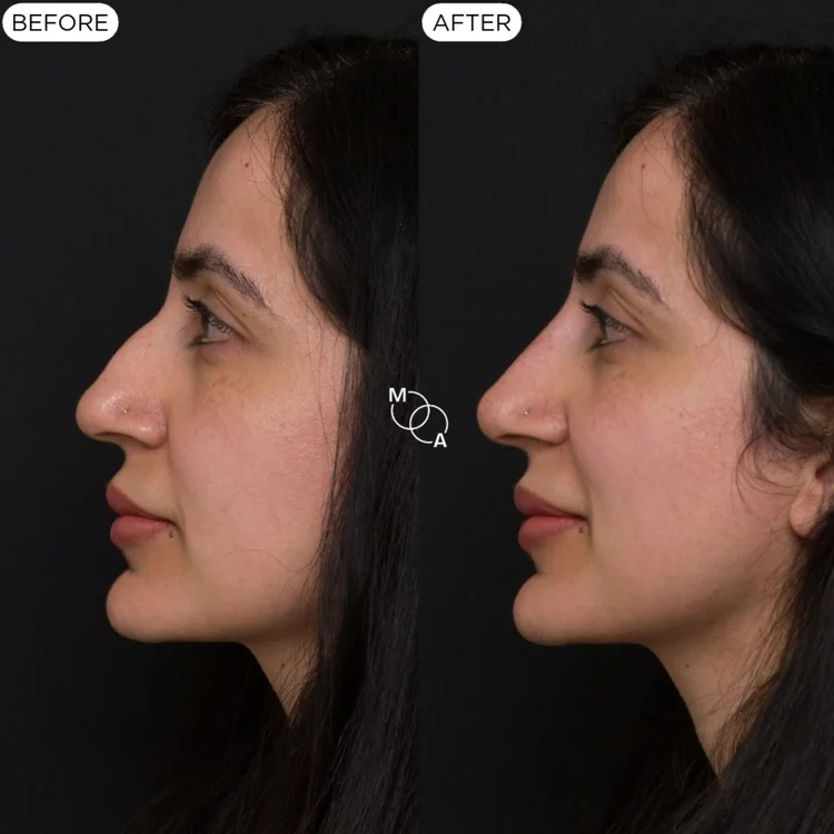 Non-surgical rhinoplasty before and after, profile view of the nose bridge, Reigate Surrey