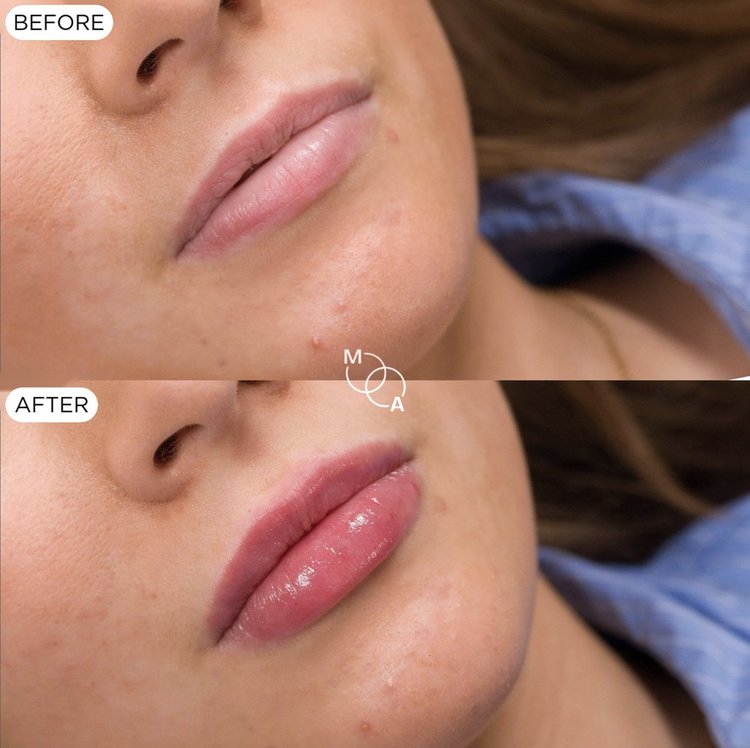 Lip filler before and after, three-quarter view, Reigate Surrey