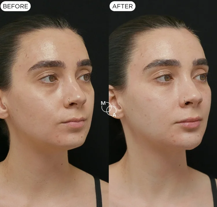 Tear trough filler before and after, three-quarter view, Reigate Surrey