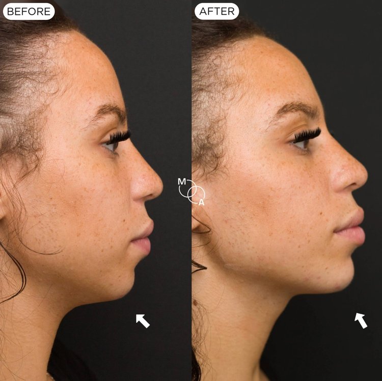 Chin and jawline filler before and after, profile view, Mindful Aesthetics Reigate