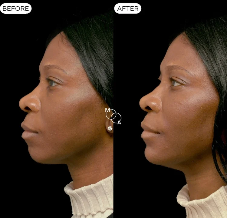 Chin and jawline filler before and after, profile view, Mindful Aesthetics Reigate