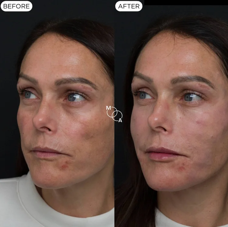 Cheek filler before and after, three-quarter view, mid-face volume, Mindful Aesthetics Reigate
