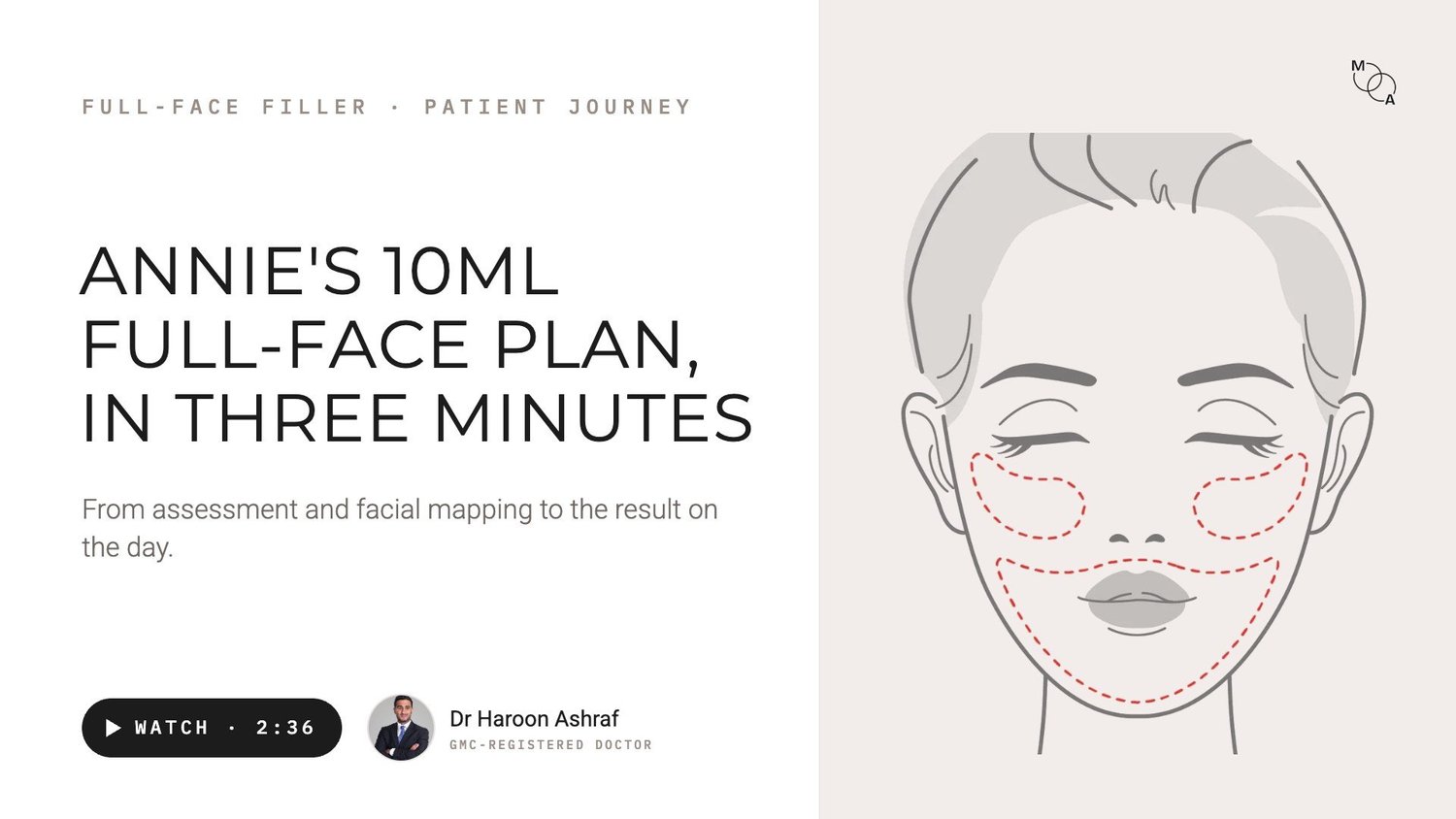 Video poster: Annie's 10ml full-face filler plan in three minutes, at Mindful Aesthetics in Reigate