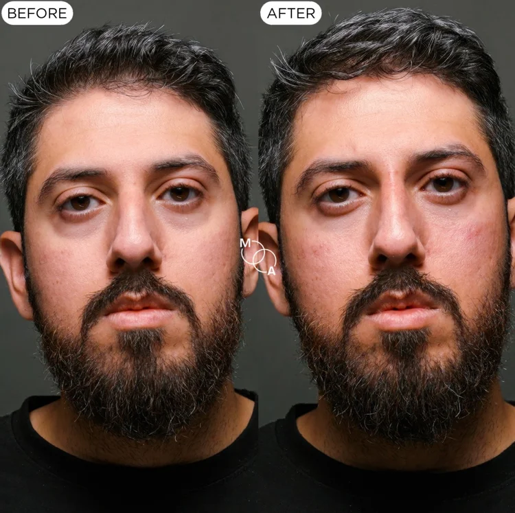 Tear trough filler before and after, front view, male patient, Mindful Aesthetics Reigate