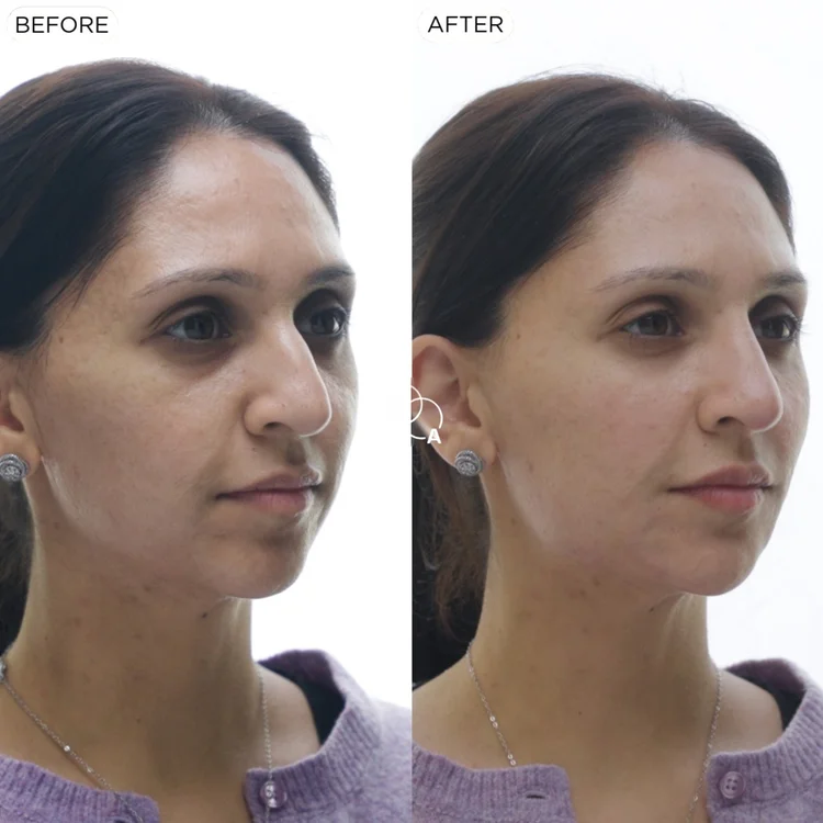 Cheek filler before and after, three-quarter view, Reigate Surrey