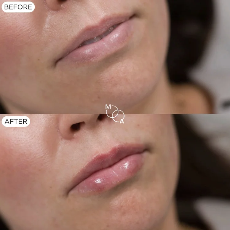 Lip filler before and after, profile view, Reigate Surrey