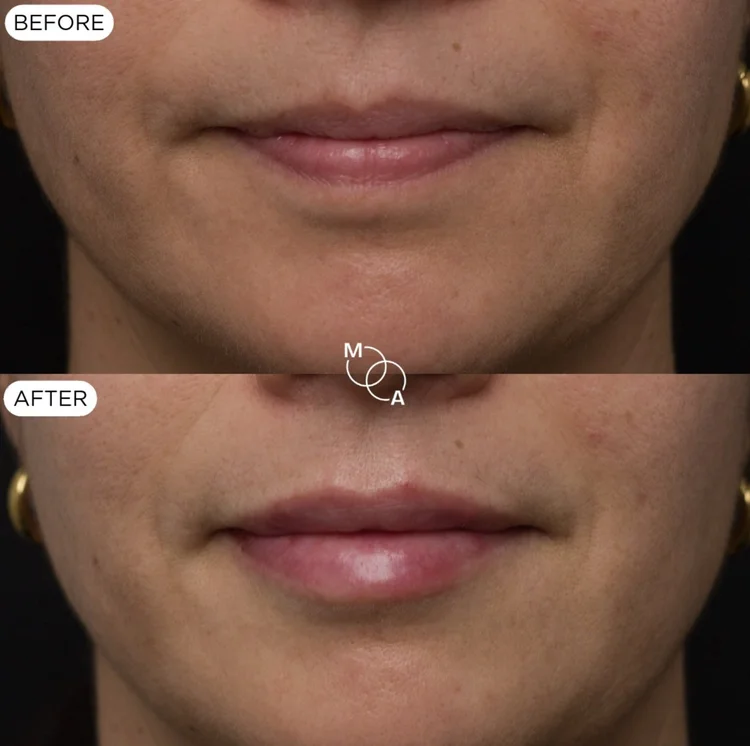 Lip filler before and after, front view, Mindful Aesthetics Reigate