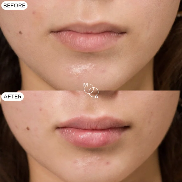 Lip filler before and after, natural lip enhancement, Mindful Aesthetics Reigate
