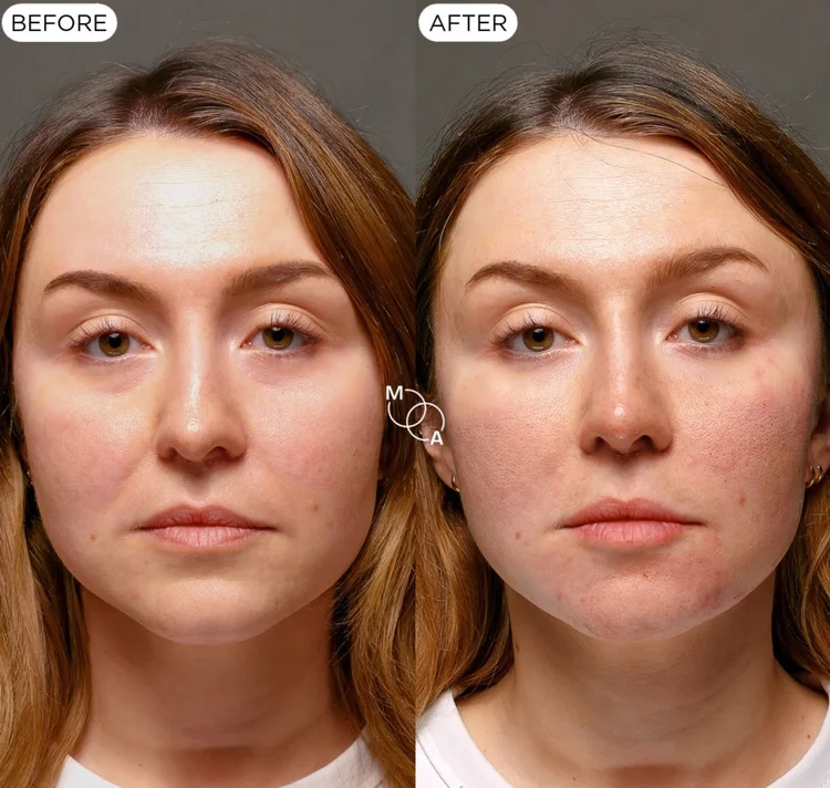 Nasolabial fold filler before and after, front view, Mindful Aesthetics Reigate
