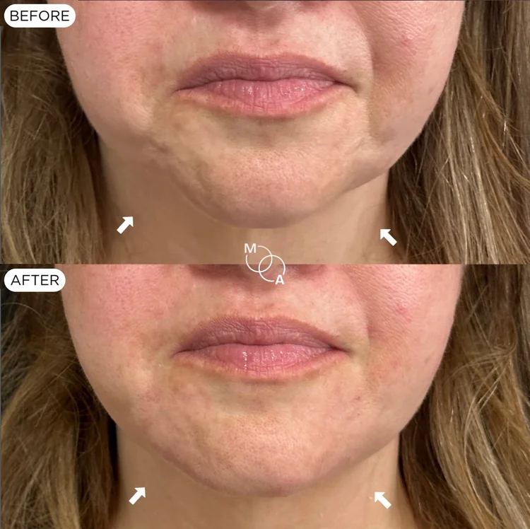 Chin and jawline filler before and after, front view of the lower face, Reigate Surrey