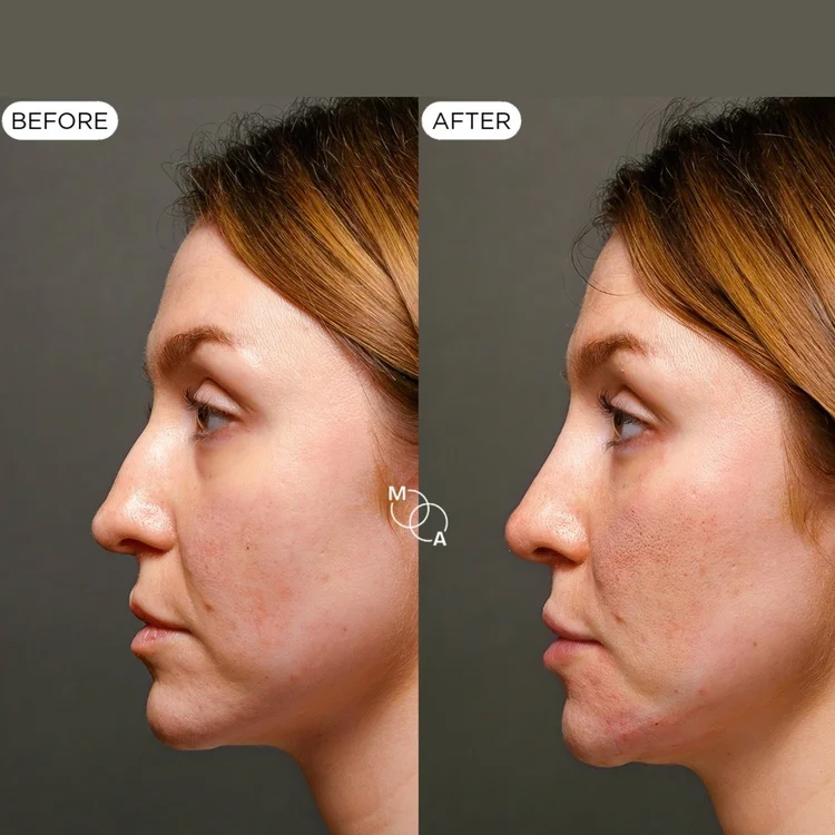 Non-surgical rhinoplasty before and after, profile view, Mindful Aesthetics Reigate