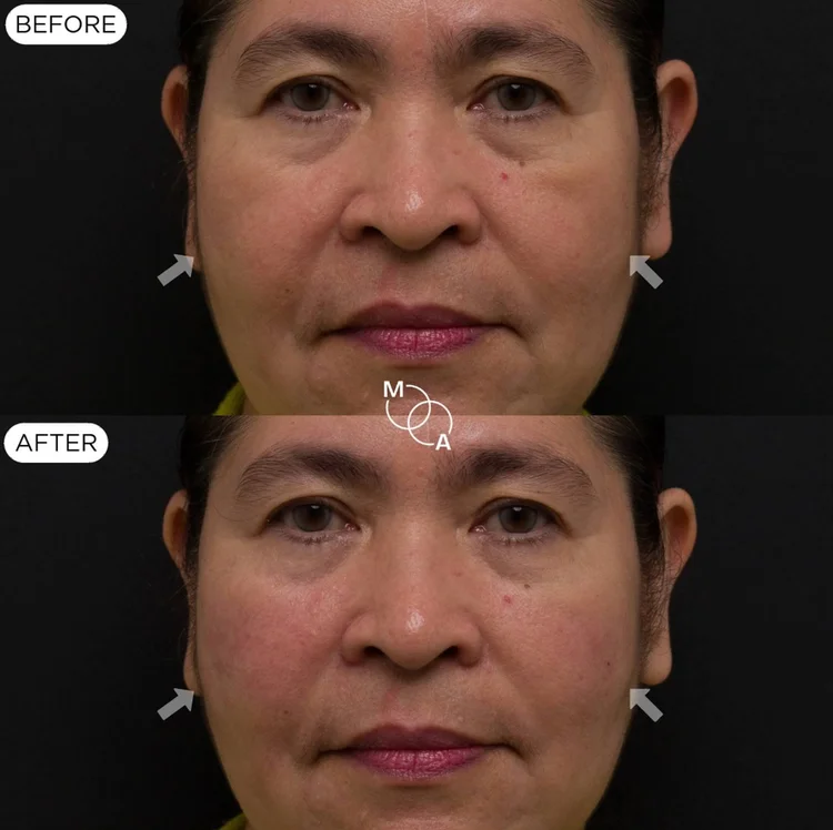 Cheek filler before and after, front view, mid-cheek, Mindful Aesthetics Reigate