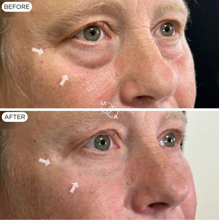Tear trough filler before and after, close-up of the under-eye area, Mindful Aesthetics Reigate