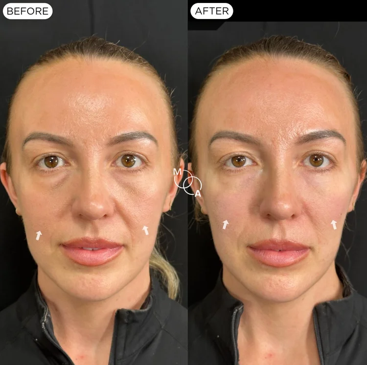 Cheek filler before and after, front view, Mindful Aesthetics Reigate