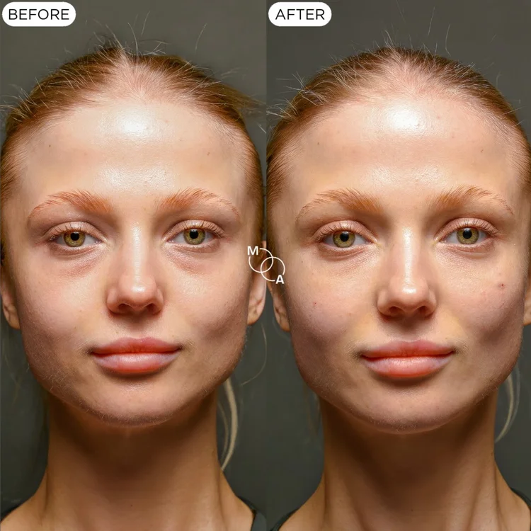 Tear trough filler before and after, front view, under-eye hollows, Reigate Surrey
