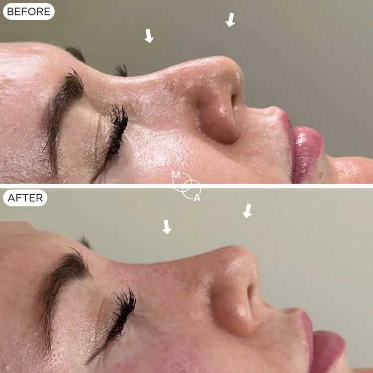 Non-surgical rhinoplasty before and after, profile close-up, Reigate Surrey