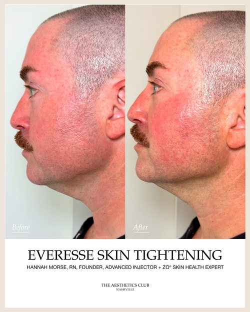 Before and after non-surgical skin tightening in Nashville