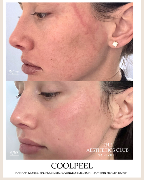 Before and after CoolPeel CO2 laser treatment