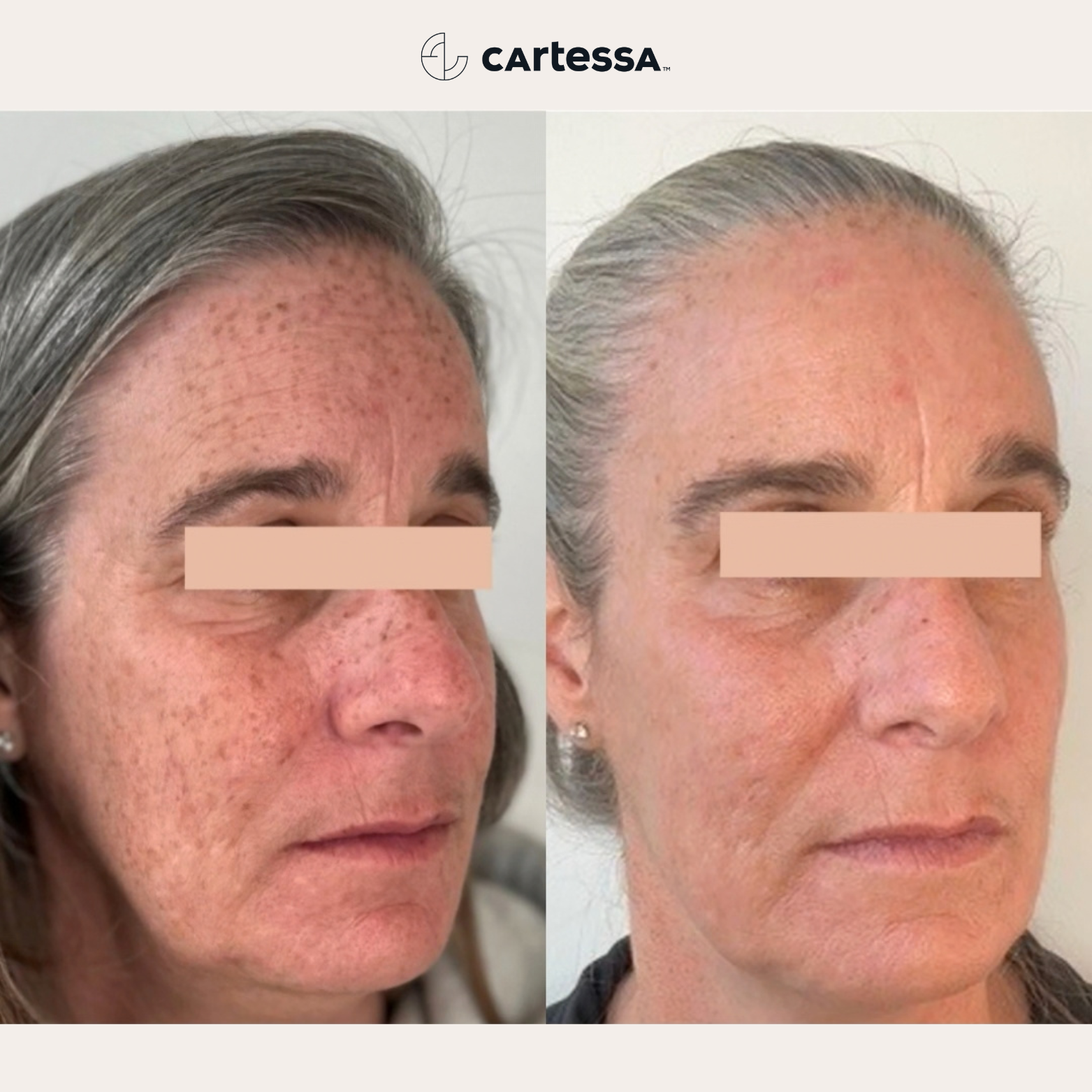 Prisma IPL Photofacial Nashville