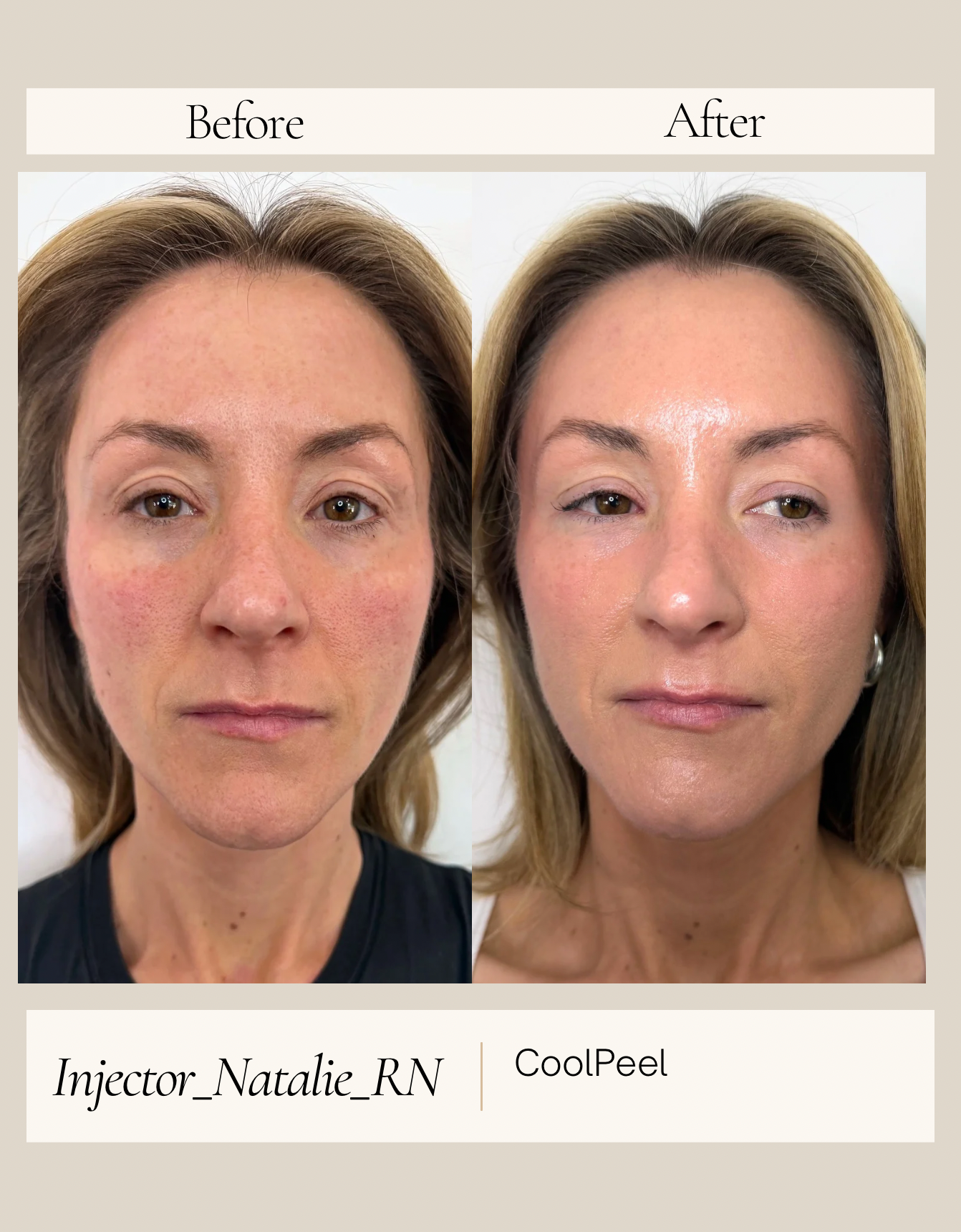 Before and after CoolPeel laser resurfacing in Nashville