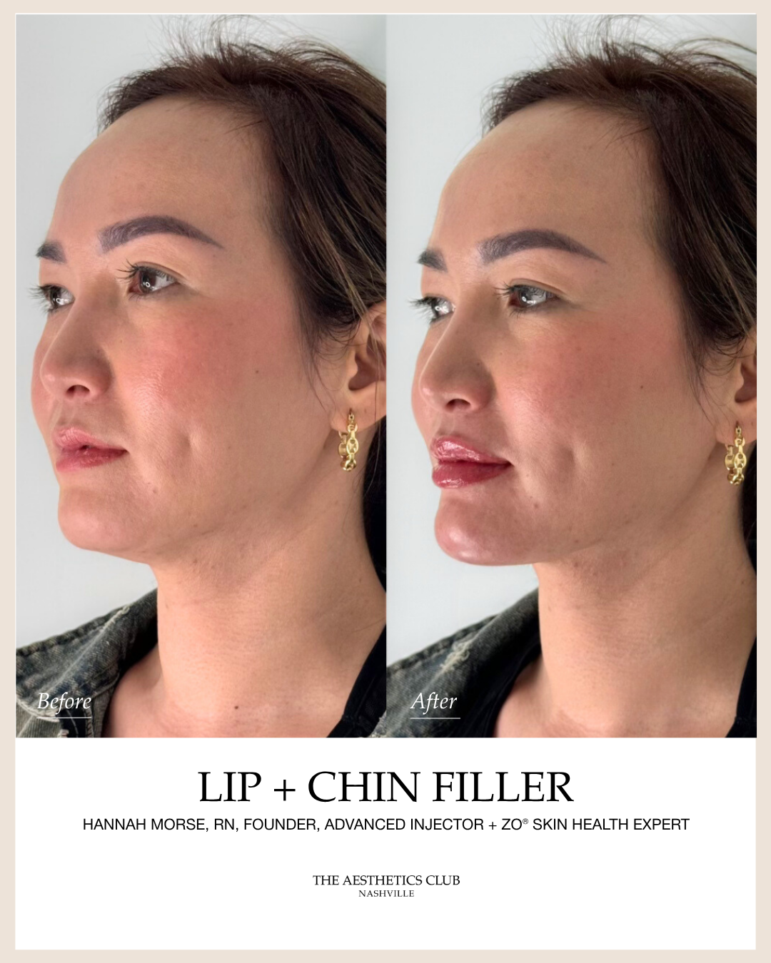 Facial Balancing before and after by Hannah Morse Cuffman RN in Nashville