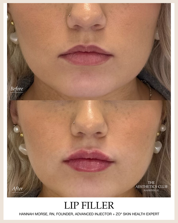 Before and after Juvederm lip filler in Nashville