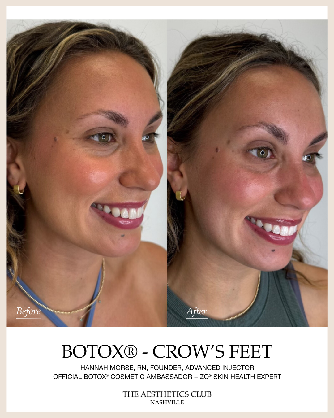 Before and after Crow’s feet Botox treatment by Hannah Morse Cuffman RN at The Aesthetics Club Nashville, Crow’s feet · Client 2