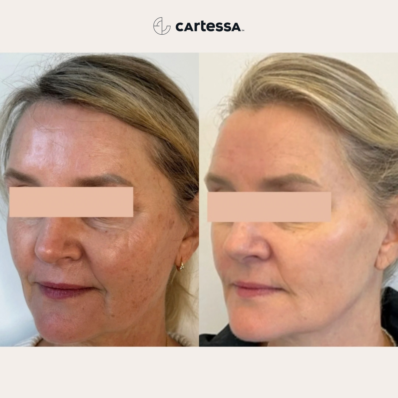 Prisma IPL skin treatment Nashville