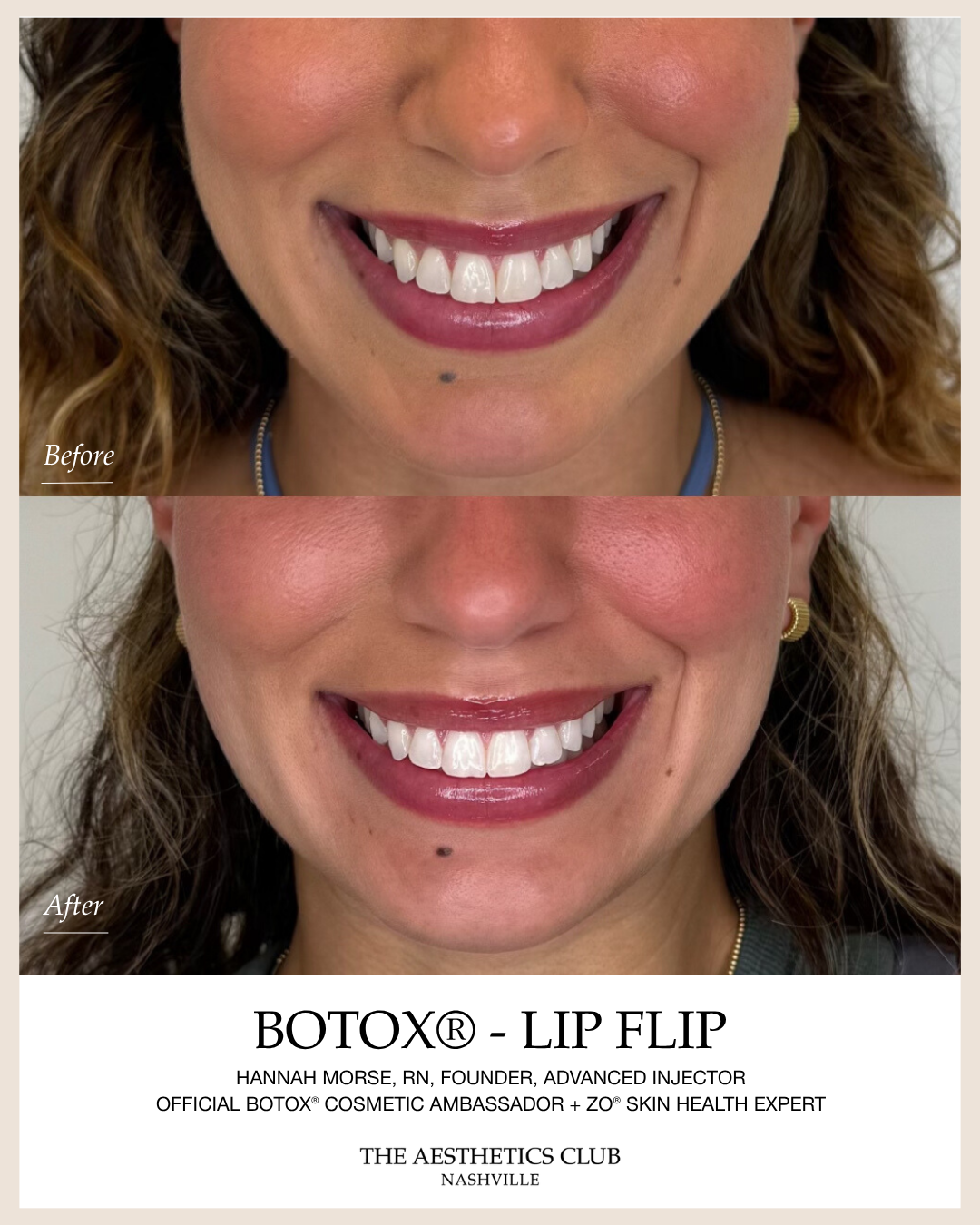 Before and after Lip flip Botox treatment by Hannah Morse Cuffman RN at The Aesthetics Club Nashville, Lip flip · Client 2