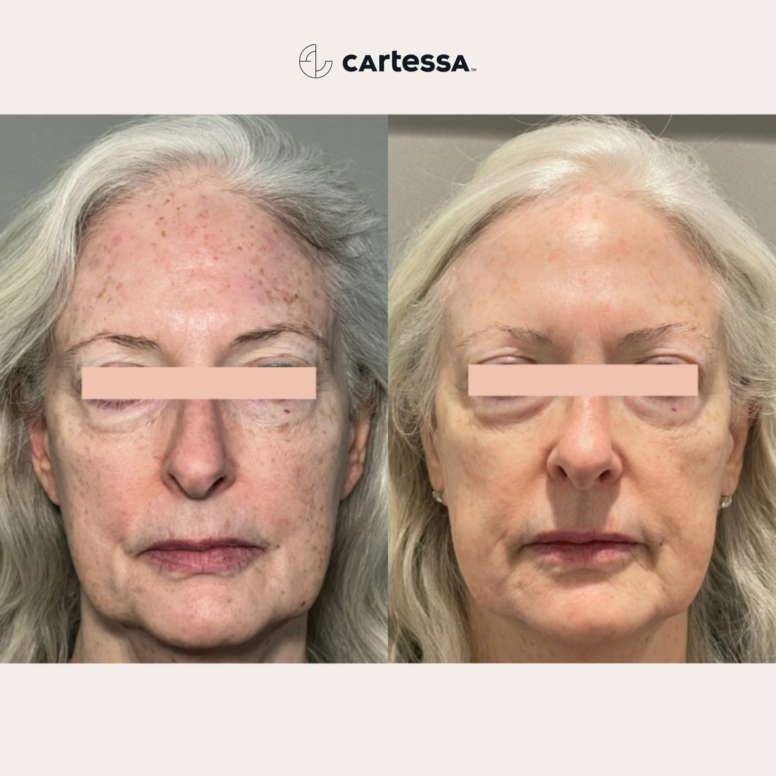IPL photofacial treatment