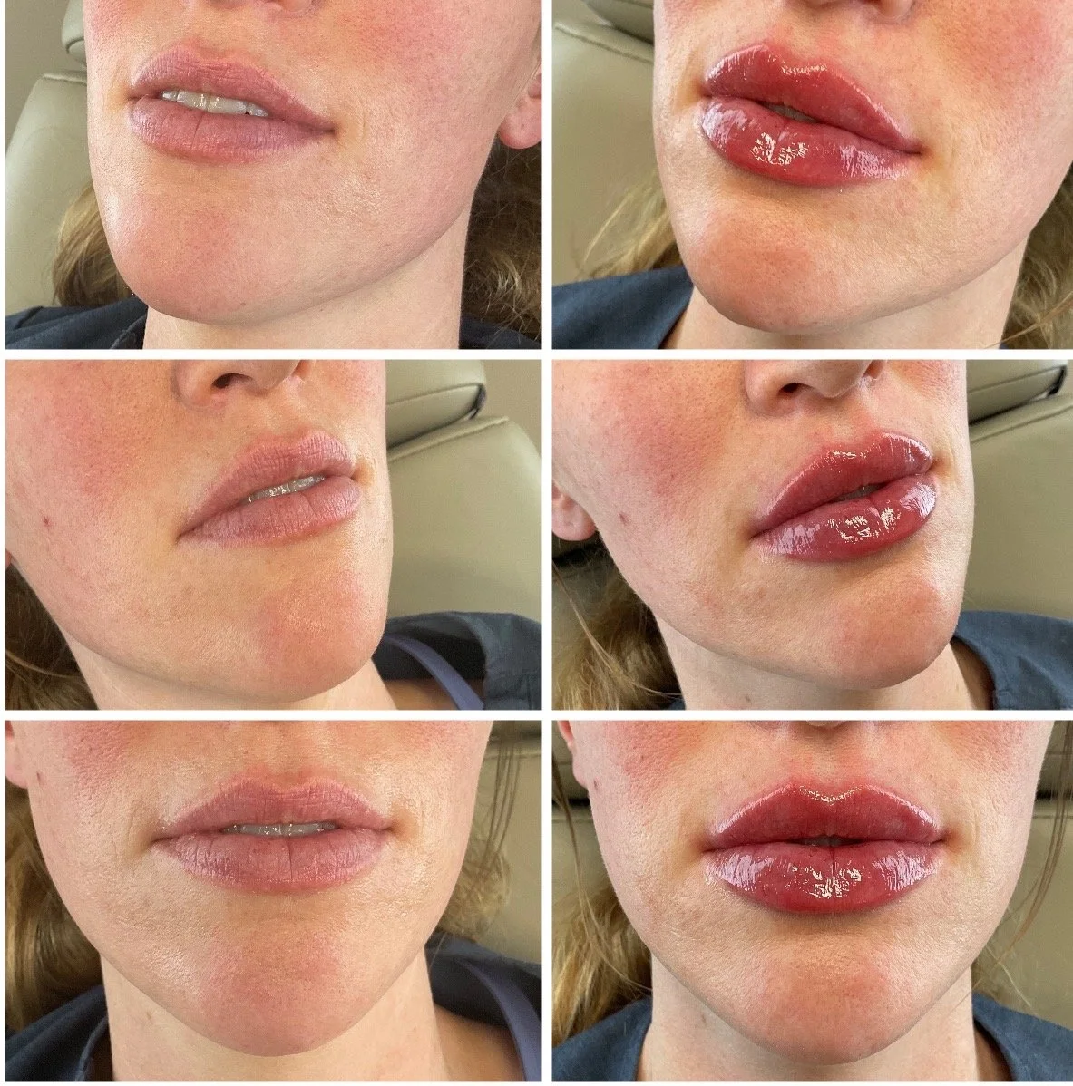 Before-and-after photographs showing lip filler with RHA by Loreen Kay