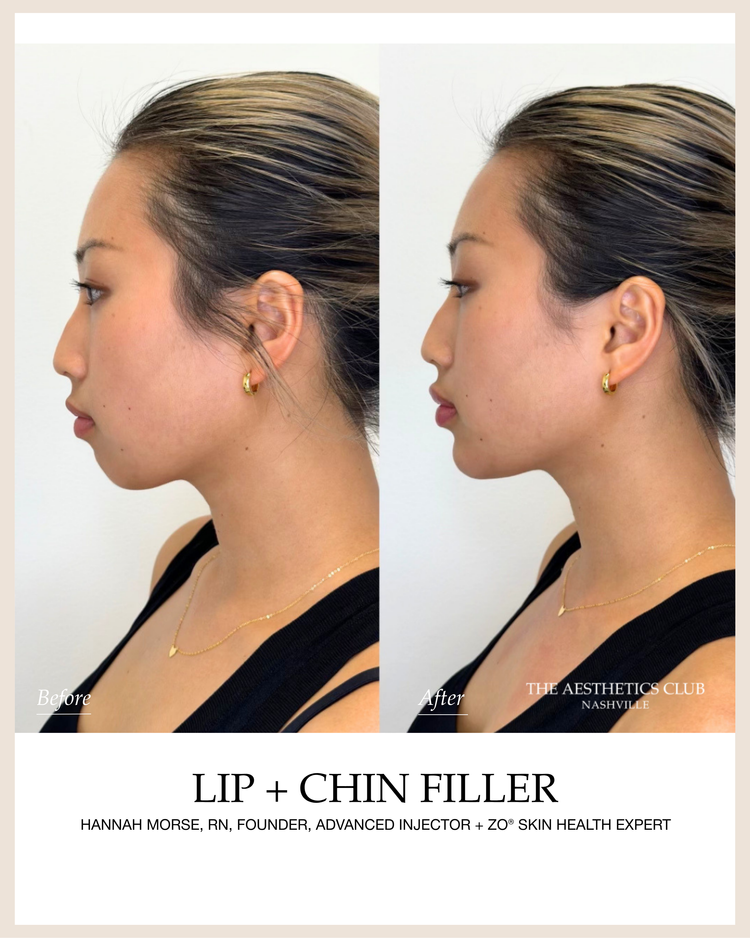 Facial Balancing before and after by Hannah Morse Cuffman RN