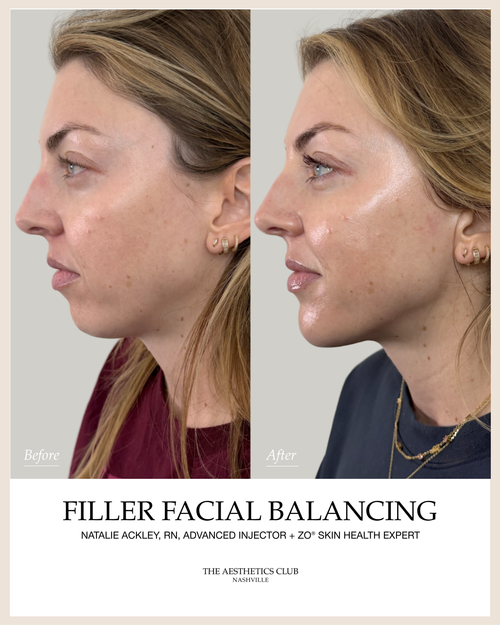 Before and after facial balancing with Juvederm filler