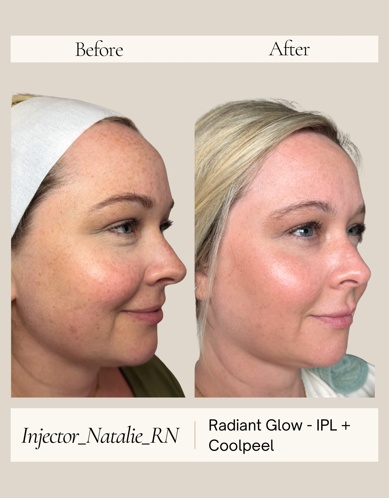 IPL with resurfacing before and after